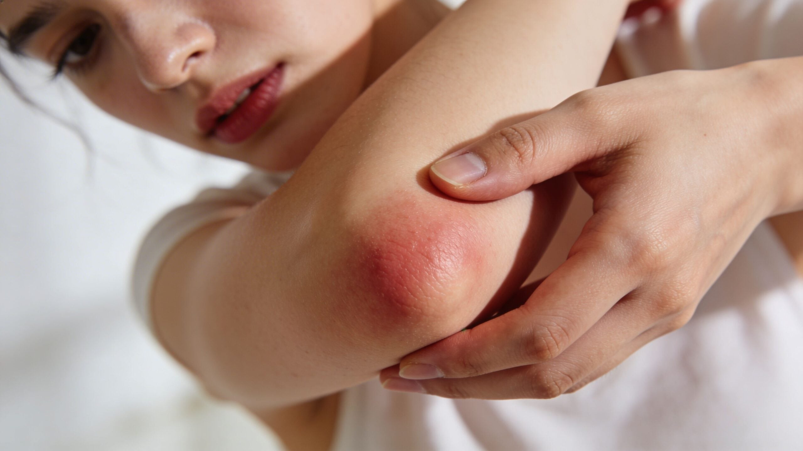 A person examining an inflamed and red patch of skin on their elbow with their fingers.
